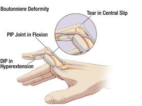 How long does it take to fix a jammed finger?