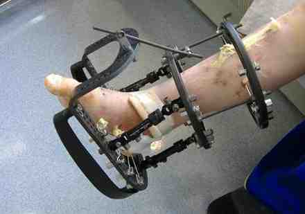 Ring fixator for Broken ankle