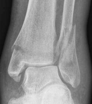 X-ray of broken ankle