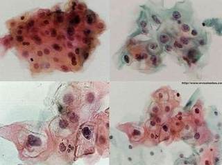 Biopsy results of LSIL under electron microscope.