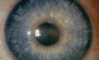 Fuchs corneal dystrophy