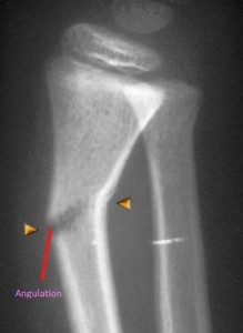 greenstick fracture