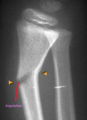 Greenstick Fracture X-ray picture