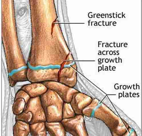 Greenstick fracture of radius (wrist)