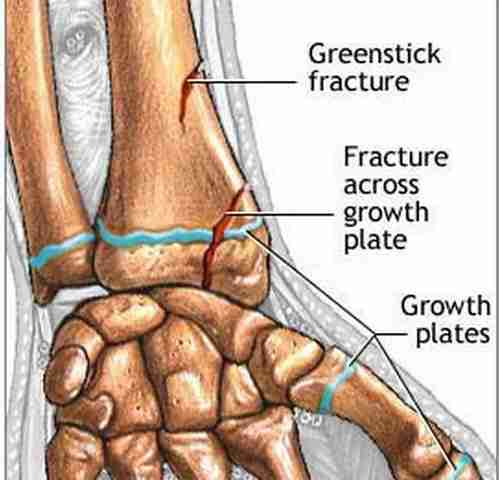 greenstick fracture distal radius