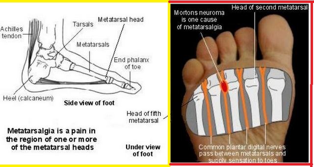 Metatarsalgia (forefoot) picture