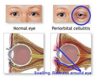 Periorbital Cellulitis eye normal eye pictures