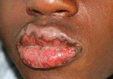 Image of Mucositis of lips in teenagers