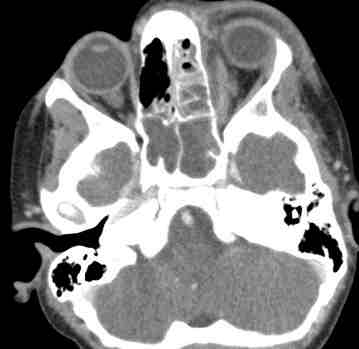 ct scan showing periorbital cellulitis image