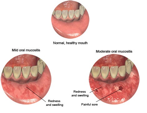 mucositis picture - redness, swelling, sore of mucus memebrane