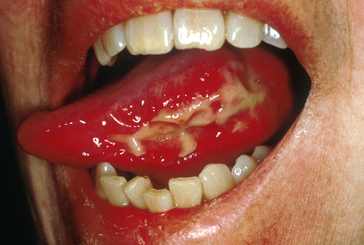 mucositis picture showing redness, swelling, ulcer of mucus membrane