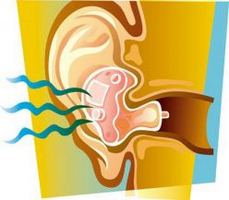 ototoxicity picture