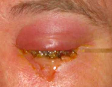 purulent discharge from periorbital cellulitis eye picture