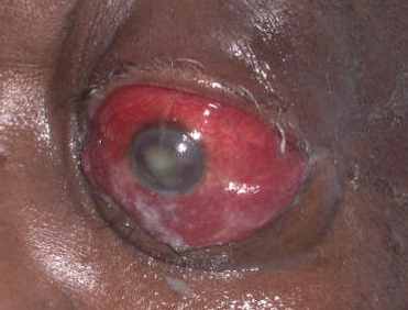 severe condition of periorbital cellulitis picture