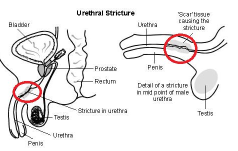 urethral stricture in balanitis xerotica obliterans