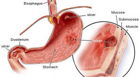 gastric ulcer picture