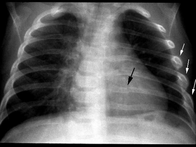Bruised Rib X-ray AP view image