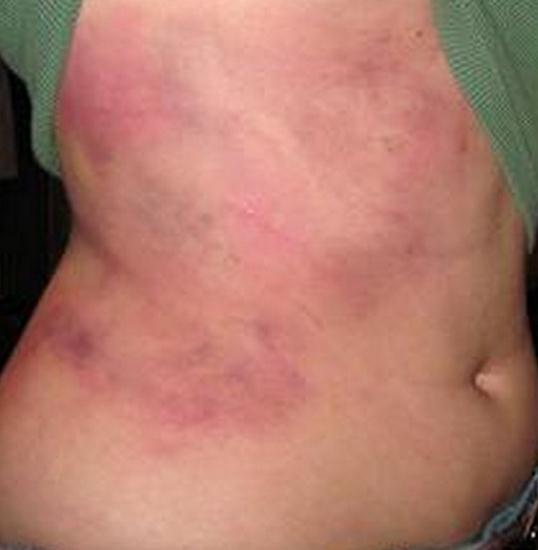 Bruised Rib showing redness externally