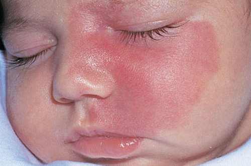 Cherry Angioma on face