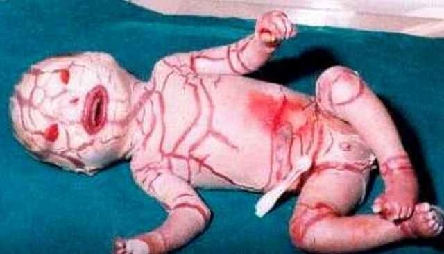 Harlequin Ichthyosis Pictures in newborn