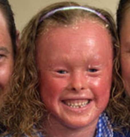 Harlequin Ichthyosis face pictures