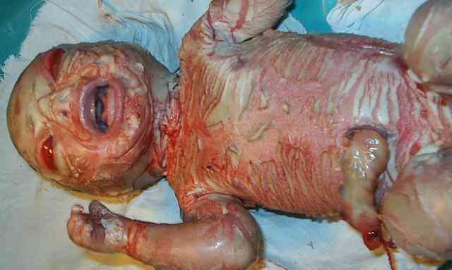 Harlequin Ichthyosis in infants