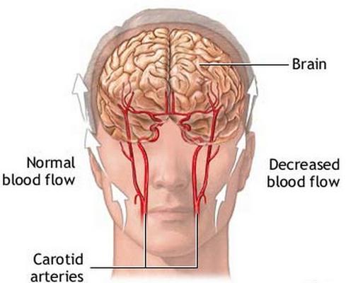 Ice Pick Headaches pathophysiology, brain image