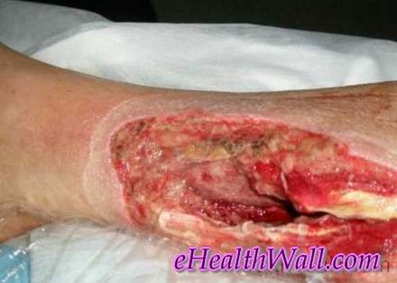 Flesh Eating Disease pics