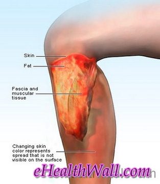 Flesh Eating Disease pictures