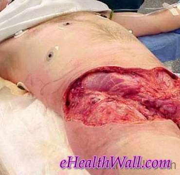 Flesh Eating Disease pictures 