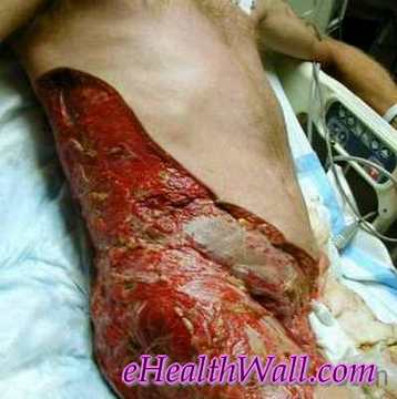 Flesh Eating Disease (necrotising fascitis)