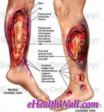 Flesh Eating Disease images