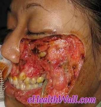 Flesh Eating Disease on face images