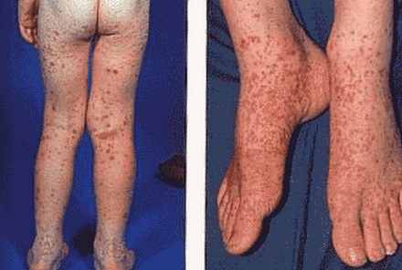 Henoch-Schonlein Purpura on legs, buttocks and thighs