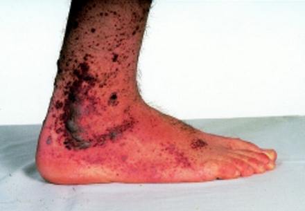 Henoch-Schonlein Purpura on legs (lateral view)