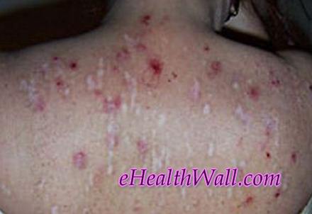 Morgellons Disease pics