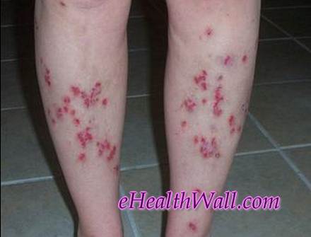 Morgellons Disease on back of legs