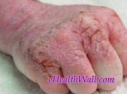 Morgellons Disease images