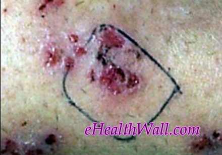 Morgellons Disease skin images