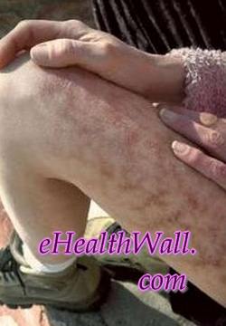 Morgellons Disease thighs pictures