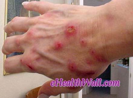 Morgellons Disease pics