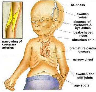 Progeria Symptoms