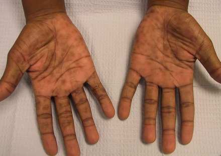 Prurigo Nodularis (hands)