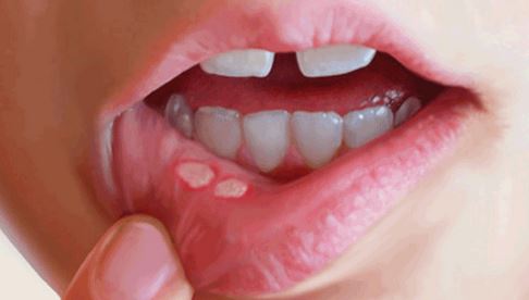 fever blister on lips