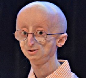 Progeria - What is?, Facts, Symptoms, Treatment, Life Expect