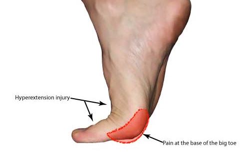 turf toe injury