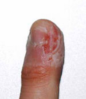 Dermatophagia pictures