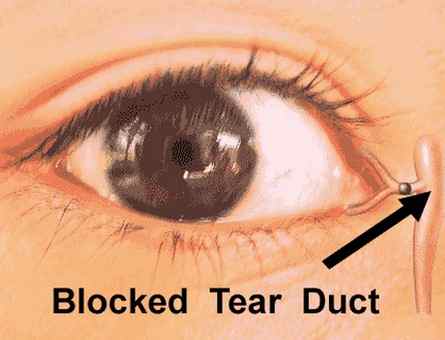 Blocked Tear Duct pictures