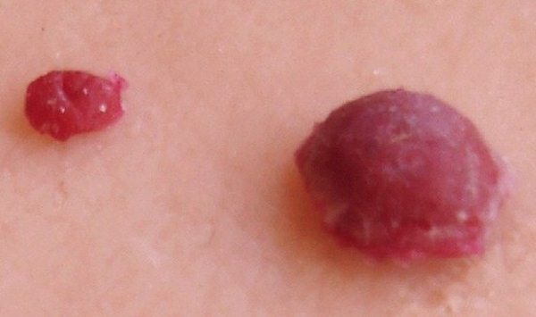 Cherry Angioma Pictures Removal Causes Home Treatment 