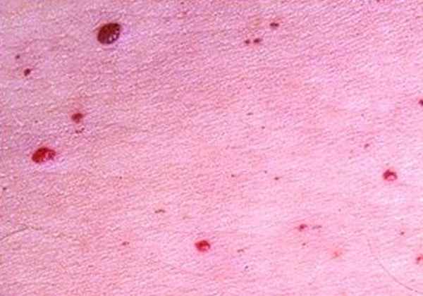 Cherry Angioma on skin